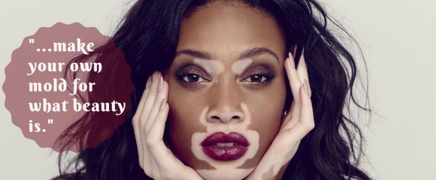 Top Model Winnie Harlow Says Living With Vitiligo Didnt Deter Her From